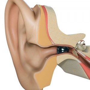 Hidden Complete In Canal Invisible Hearing Aid